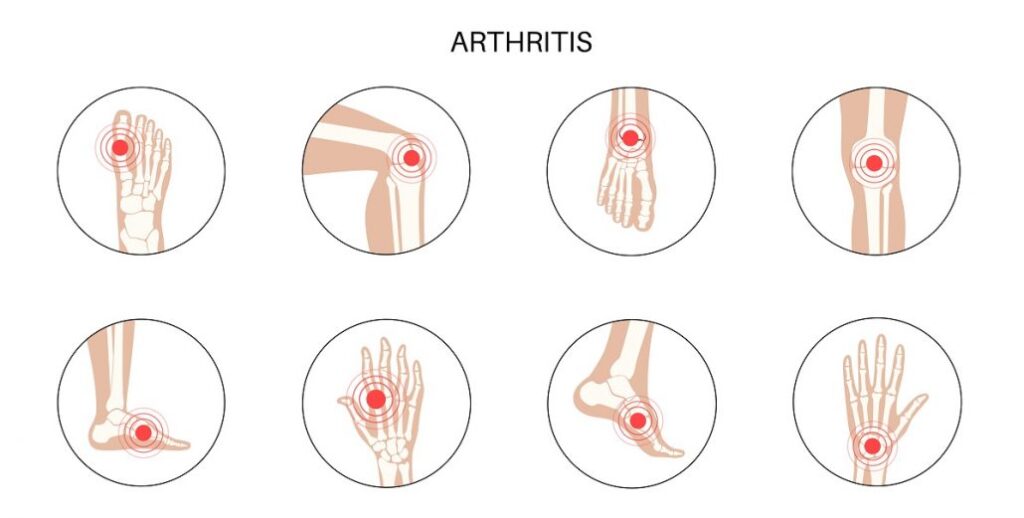 Arthritis concept revmatoidni artritis