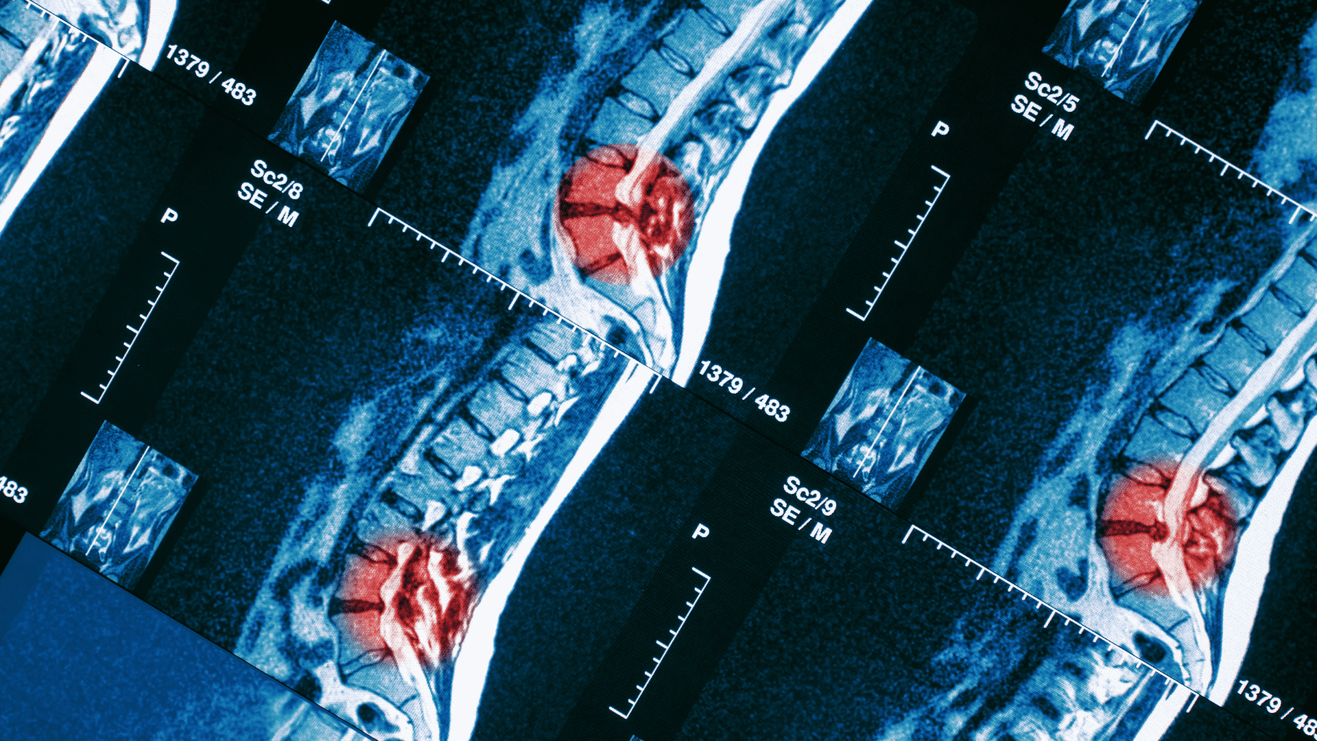 hernija