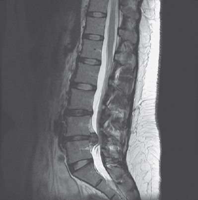 Slika, pridobljena z magnetno resonanco, ki prikazuje hernijo diska