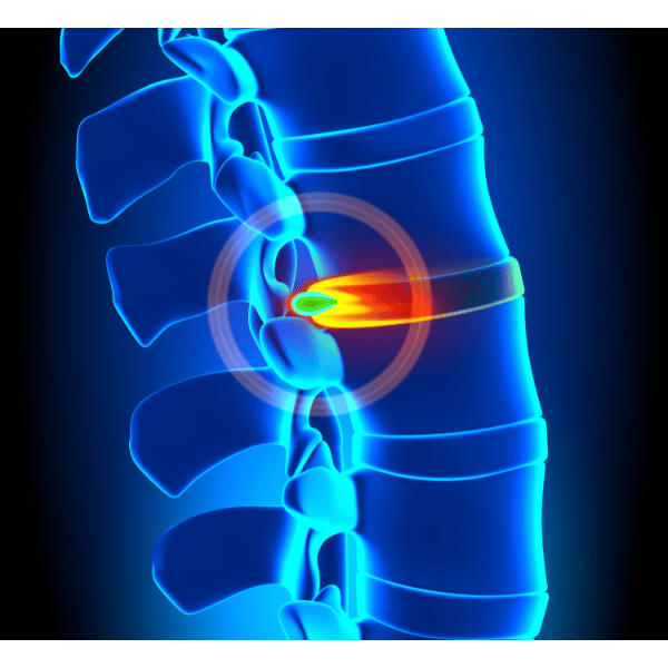 Hernija diska