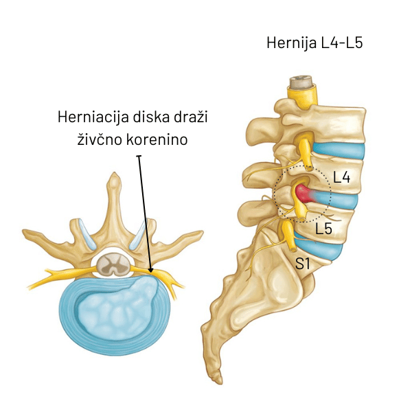 Anatomski prikaz ledvene hrbtenice, kje najpogosteje pride do hernije in kako hernija diska lahko draži živčno korenino in s tem povzroča išias