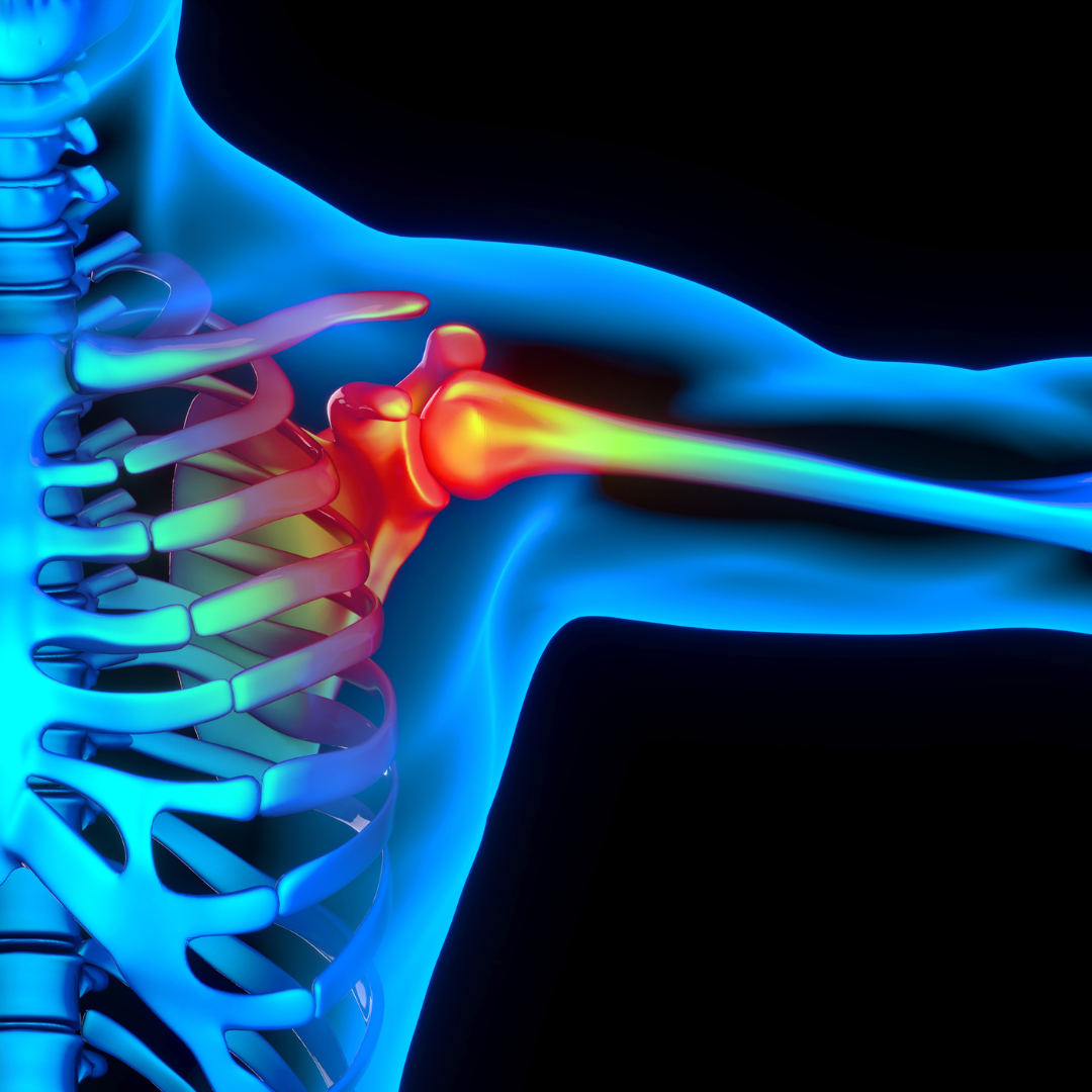 Nestabilnost ramenskega sklepa