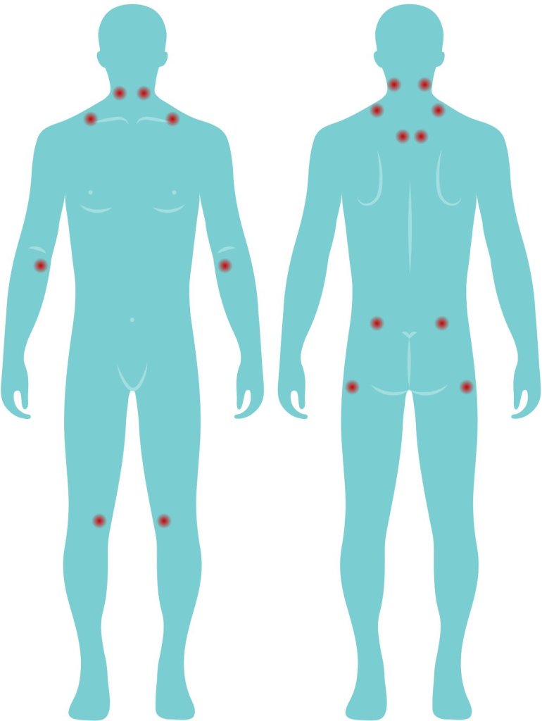 Bolečinske točke pri osebah, ki imajo fibromialgijo