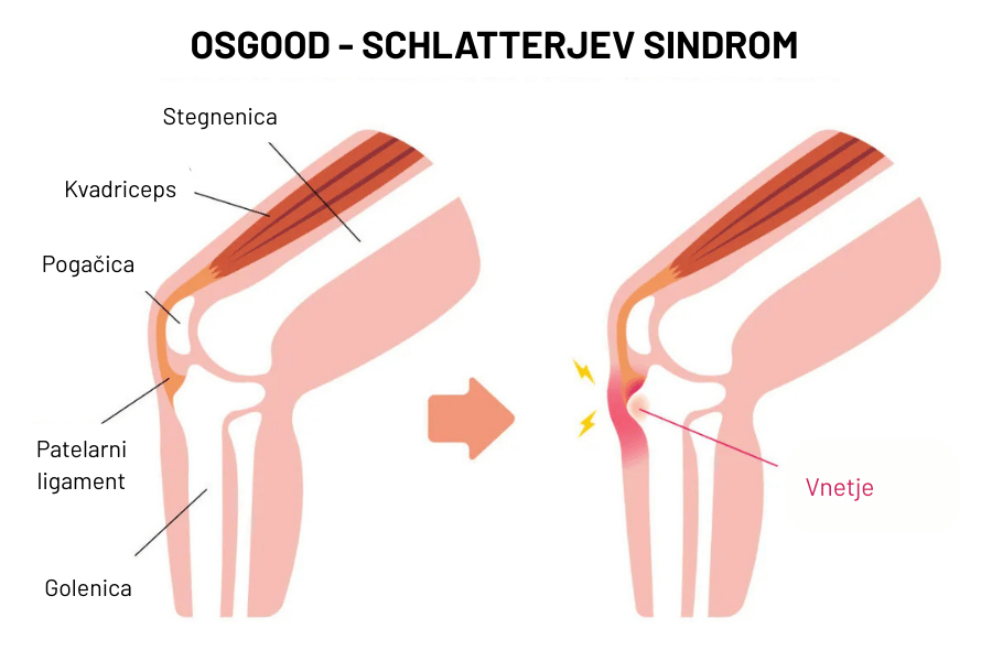 Osgood-Schlatterjev sindrom