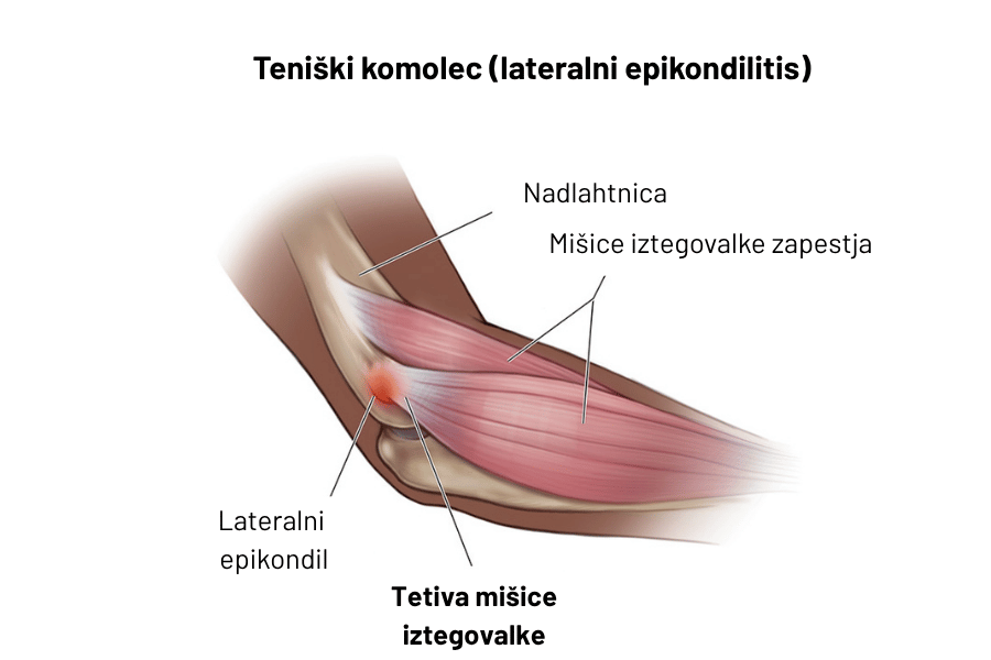 Teniški komolec anatomija
