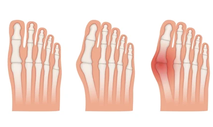 hallux valgus